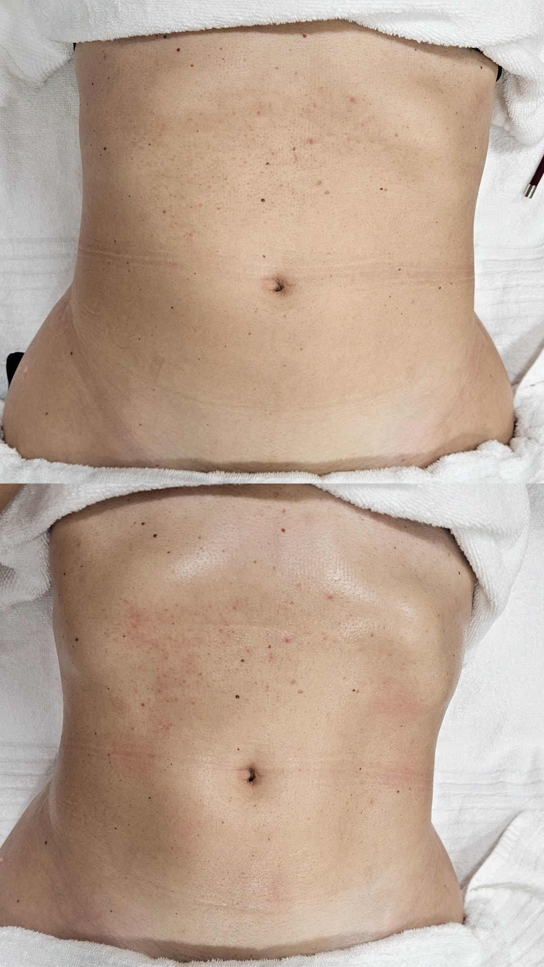 Antes e depois da drenagem linfática, resultado 2