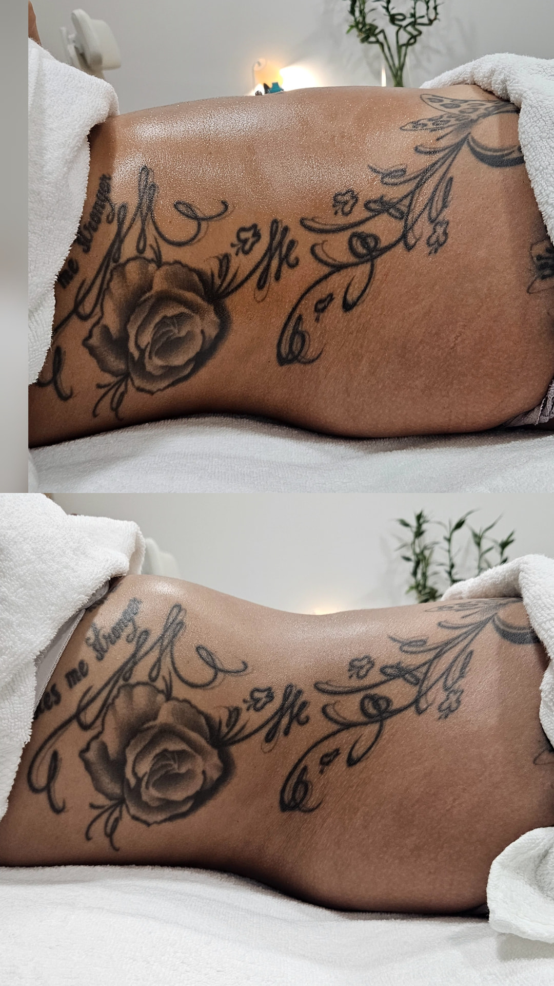 Antes e depois da drenagem linfática, resultado 3